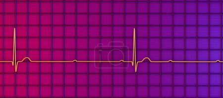 Photo for 3D illustration visualizing an ECG with 3rd degree AV block, showing complete dissociation between atrial and ventricular rhythms. - Royalty Free Image
