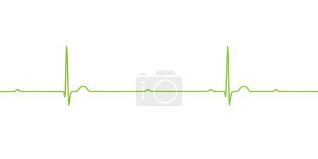 Photo for 3D illustration visualizing an ECG with 3rd degree AV block, showing complete dissociation between atrial and ventricular rhythms. - Royalty Free Image
