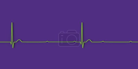 3D-Illustration zur Visualisierung eines EKGs mit AV-Block 3. Grades, die die vollständige Dissoziation zwischen atrialem und ventrikulärem Rhythmus zeigt.