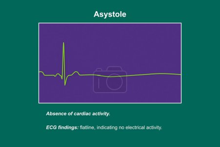 Asystole, une condition critique marquée par l'absence de toute activité électrique cardiaque. L'illustration 3D montre une ligne plane sur l'ECG, signifiant un c?ur non fonctionnel sans pouls ni battements de c?ur.
