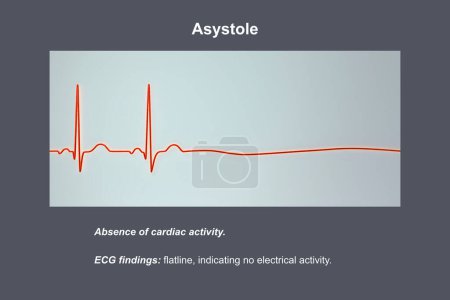 Asystole, ein kritischer Zustand, der durch das Fehlen jeglicher kardialer elektrischer Aktivität gekennzeichnet ist. 3D-Illustration zeigt eine flache Linie auf dem EKG, was auf ein nicht funktionierendes Herz ohne Puls oder Herzschlag hindeutet.