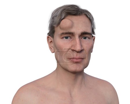 Lipoma sur le front d'un homme, une tumeur non cancéreuse composée de tissu adipeux, illustration 3D.