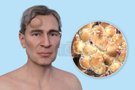 Lipoma en la frente de un hombre, y vista de cerca de los adipocitos, las células grasas que constituyen el crecimiento del lipoma, ilustración 3D.