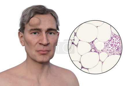 3D-Illustration des Lipoms auf der Stirn eines Mannes und Lichtmikroskopie der Fettzellen, die das Wachstum des Lipoms bilden,