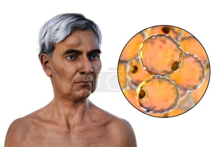 Photo for Lipoma on a man's forehead, and close-up view of adipocytes, the fat cells constituting the lipoma growth, 3D illustration. - Royalty Free Image