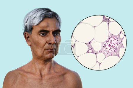 3D-Illustration des Lipoms auf der Stirn eines Mannes und Lichtmikroskopie der Fettzellen, die das Wachstum des Lipoms bilden,