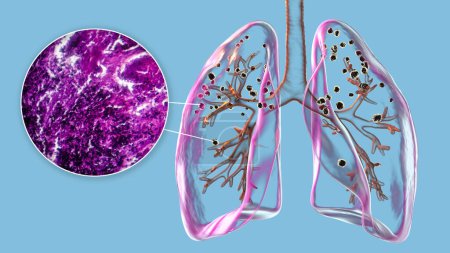 Ilustración 3D y micrografía de luz que representa los pulmones afectados por la silicosis dentro de un cuerpo humano, revelando nódulos silicóticos oscuros, haciendo hincapié en los problemas de salud respiratoria debido a la exposición al sílice.