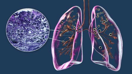 Téléchargez les photos : Illustration 3D et micrographie photonique représentant les poumons affectés par la silicose dans un corps humain, révélant des nodules silicotiques sombres, mettant l'accent sur les problèmes de santé respiratoire dus à l'exposition à la silice. - en image libre de droit
