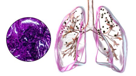 Illustration 3D et micrographie photonique représentant les poumons affectés par la silicose, révélant des nodules silicotiques sombres, mettant l'accent sur les problèmes de santé respiratoire dus à l'exposition à la silice.