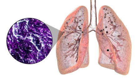 Photo for 3D illustration and light micrograph depicting lungs affected by silicosis, revealing dark silicotic nodules, emphasizing respiratory health issues due to silica exposure. - Royalty Free Image