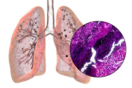 Illustration 3D et micrographie photonique représentant les poumons affectés par la silicose, révélant des nodules silicotiques sombres, mettant l'accent sur les problèmes de santé respiratoire dus à l'exposition à la silice.