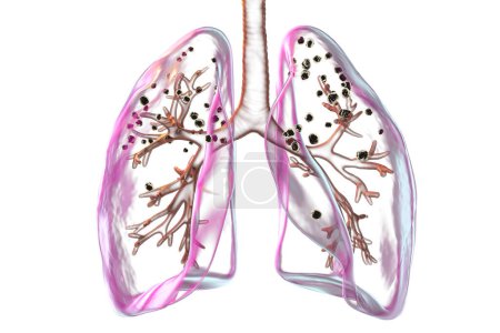 Téléchargez les photos : Poumons affectés par la silicose, illustration 3D révélant des nodules silicotiques foncés, mettant l'accent sur les problèmes de santé respiratoire dus à l'exposition à la silice. - en image libre de droit