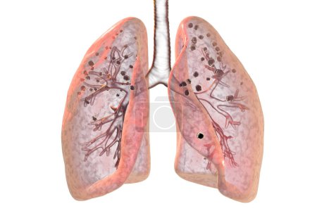 Lungs affected by silicosis, 3D illustration revealing dark silicotic nodules, emphasizing respiratory health issues due to silica exposure.