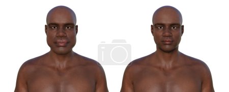Acromegaly in a man (left) and the same healthy person (right), 3D illustration showing enlarged facial features due to overproduction of somatotrophin caused by a tumour of the pituitary gland.