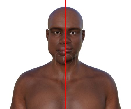 Acromégalie chez un homme (à gauche) et la même personne en bonne santé (à droite), illustration 3D montrant des traits faciaux élargis dus à une surproduction de somatotrophine causée par une tumeur de l'hypophyse.