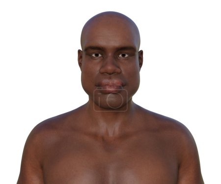Acromegaly, 3D illustration showing enlarged facial features, thickened lips, broadened nose, protruding jaw, due to overproduction of somatotrophin caused by a tumour of the pituitary gland.
