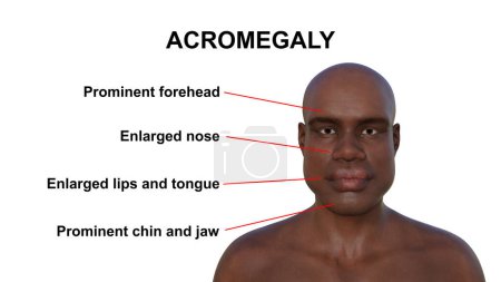 Acromegalia, ilustración 3D que muestra rasgos faciales agrandados, labios engrosados, nariz ensanchada, mandíbula sobresaliente, debido a la sobreproducción de somatotropina causada por un tumor de la glándula pituitaria.