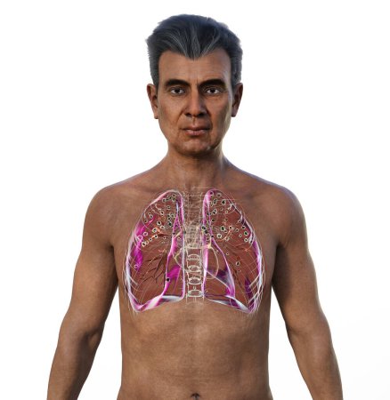 Un homme aux poumons atteints de silicose, illustration 3D révélant des nodules silicotiques foncés, mettant l'accent sur les problèmes de santé respiratoire dus à l'exposition à la silice.