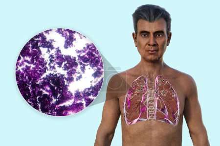 Photo for 3D illustration and light micrograph depicting a man with lungs affected by silicosis, revealing dark silicotic nodules, emphasizing respiratory health issues due to silica exposure. - Royalty Free Image