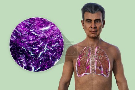 Foto de Ilustración 3D y micrografía de luz que representa a un hombre con pulmones afectados por silicosis, revelando nódulos silicóticos oscuros, enfatizando problemas de salud respiratoria debido a la exposición al sílice. - Imagen libre de derechos