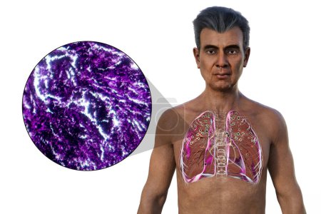 Téléchargez les photos : Illustration 3D et micrographie photonique représentant un homme avec des poumons affectés par la silicose, révélant des nodules silicotiques sombres, mettant l'accent sur les problèmes de santé respiratoire dus à l'exposition à la silice. - en image libre de droit