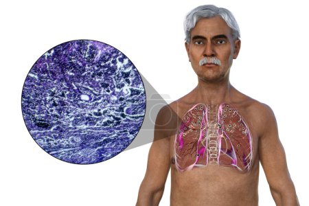 Illustration 3D et micrographie photonique représentant un homme avec des poumons affectés par la silicose, révélant des nodules silicotiques sombres, mettant l'accent sur les problèmes de santé respiratoire dus à l'exposition à la silice.