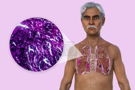3D illustration and light micrograph depicting a man with lungs affected by silicosis, revealing dark silicotic nodules, emphasizing respiratory health issues due to silica exposure.