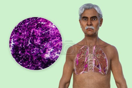 Téléchargez les photos : Illustration 3D et micrographie photonique représentant un homme avec des poumons affectés par la silicose, révélant des nodules silicotiques sombres, mettant l'accent sur les problèmes de santé respiratoire dus à l'exposition à la silice. - en image libre de droit