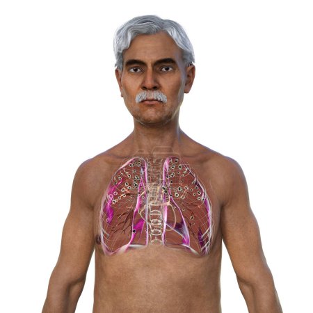 Téléchargez les photos : Un homme aux poumons atteints de silicose, illustration 3D révélant des nodules silicotiques foncés, mettant l'accent sur les problèmes de santé respiratoire dus à l'exposition à la silice. - en image libre de droit