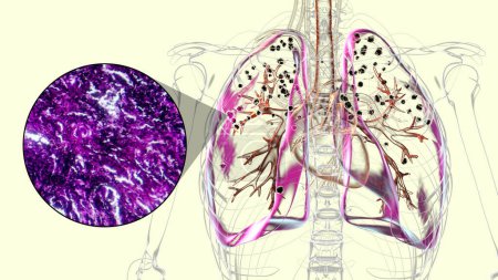 Ilustración 3D y micrografía de luz que representa los pulmones afectados por la silicosis dentro de un cuerpo humano, revelando nódulos silicóticos oscuros, haciendo hincapié en los problemas de salud respiratoria debido a la exposición al sílice.
