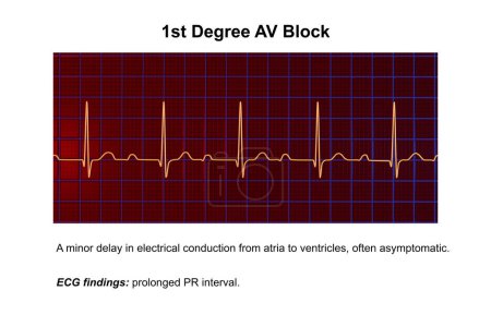 Ilustración 3D de un ECG que muestra bloqueo AV de primer grado, un trastorno de la conducción cardíaca.