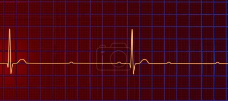 Foto de Ilustración 3D visualizando un ECG con bloqueo AV de 3er grado, mostrando disociación completa entre ritmos auriculares y ventriculares. - Imagen libre de derechos