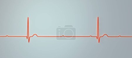 Foto de Ilustración 3D visualizando un ECG con bloqueo AV de 3er grado, mostrando disociación completa entre ritmos auriculares y ventriculares. - Imagen libre de derechos