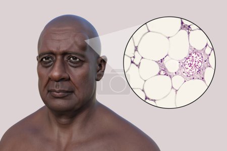 Photo for 3D illustration of lipoma on a man's forehead, and light micrograph of adipocytes, the fat cells constituting the lipoma growth, - Royalty Free Image