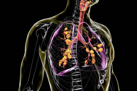 Téléchargez les photos : Poumons affectés par la mucoviscidose, un trouble génétique causant une production épaisse de mucus. Illustration 3D montrant une dilatation bronchique due à l'accumulation de mucus et à l'inflammation. - en image libre de droit