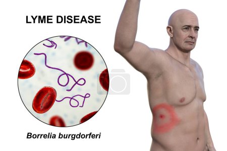 Un hombre con eritema migrans, una erupción característica de la enfermedad de Lyme causada por Borrelia burgdorferi. Ilustración 3D representa lesión de la piel, y vista de cerca de la bacteria Borrelia en su sangre.