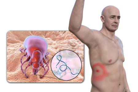 A man with erythema migrans, the characteristic rash of Lyme disease caused by Borrelia burgdorferi. The 3D illustration depicts the skin lesion, a close-up view of a tick vector, and Borrelia bacteria.