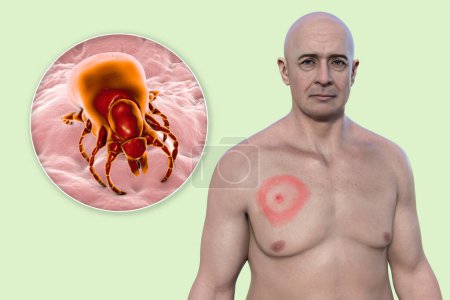 Ein Mann mit Erythema migrans, dem charakteristischen Ausschlag der Lyme-Borreliose durch Borrelia burgdorferi verursacht. Die 3D-Illustration zeigt die Hautläsion und eine Nahaufnahme eines Zeckenvektors.