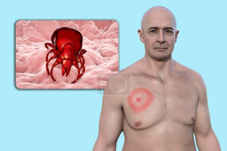 Un homme avec érythème migrant, l'éruption cutanée caractéristique de la maladie de Lyme causée par Borrelia burgdorferi. L'illustration 3D représente la lésion cutanée, et une vue rapprochée d'un vecteur de tiques.