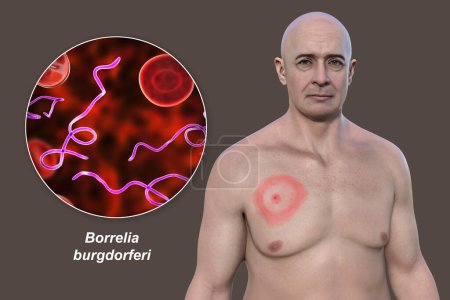 Ein Mann mit Erythema migrans, ein charakteristischer Ausschlag der Lyme-Borreliose durch Borrelia burgdorferi verursacht. 3D-Illustration zeigt Hautläsion, und Nahaufnahme von Borrelien in seinem Blut.