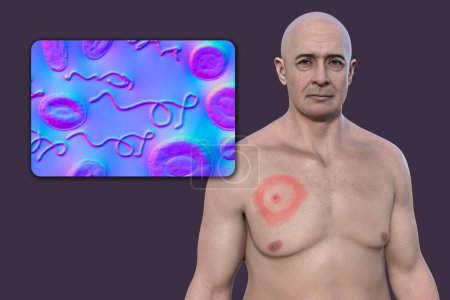 Un hombre con eritema migrans, una erupción característica de la enfermedad de Lyme causada por Borrelia burgdorferi. Ilustración 3D representa lesión de la piel, y vista de cerca de la bacteria Borrelia en su sangre.