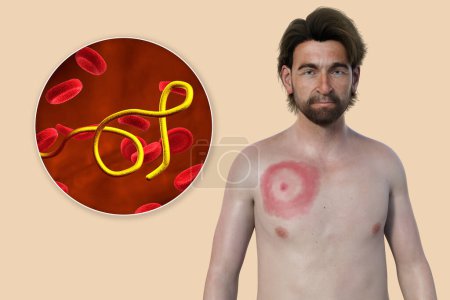 Ein Mann mit Erythema migrans, ein charakteristischer Ausschlag der Lyme-Borreliose durch Borrelia burgdorferi verursacht. 3D-Illustration zeigt Hautläsion, und Nahaufnahme von Borrelien in seinem Blut.
