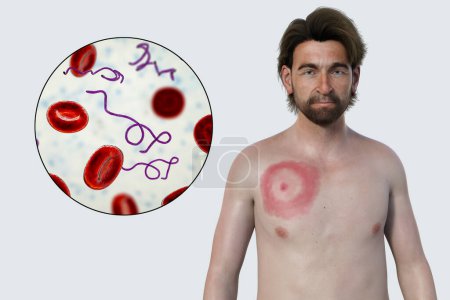 Photo for A man with erythema migrans, a characteristic rash of Lyme disease caused by Borrelia burgdorferi. 3D illustration depicts skin lesion, and close-up view of Borrelia bacteria in his blood. - Royalty Free Image