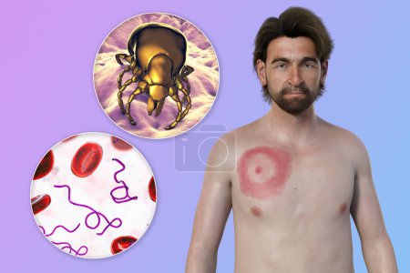 A man with erythema migrans, the characteristic rash of Lyme disease caused by Borrelia burgdorferi. The 3D illustration depicts the skin lesion, a close-up view of a tick vector, and Borrelia bacteria.