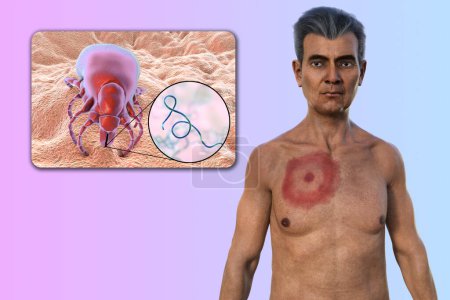 Ein Mann mit Erythema migrans, dem charakteristischen Ausschlag der Lyme-Borreliose durch Borrelia burgdorferi verursacht. Die 3D-Illustration zeigt die Hautläsion, eine Nahaufnahme eines Zeckenvektors und Borrelien.