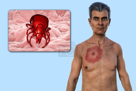 A man with erythema migrans, the characteristic rash of Lyme disease caused by Borrelia burgdorferi. The 3D illustration depicts the skin lesion, and a close-up view of a tick vector.
