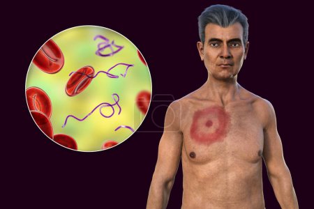 Un homme avec érythème migrant, une éruption cutanée caractéristique de la maladie de Lyme causée par Borrelia burgdorferi. Illustration 3D représentant une lésion cutanée, et vue rapprochée de la bactérie Borrelia dans son sang.