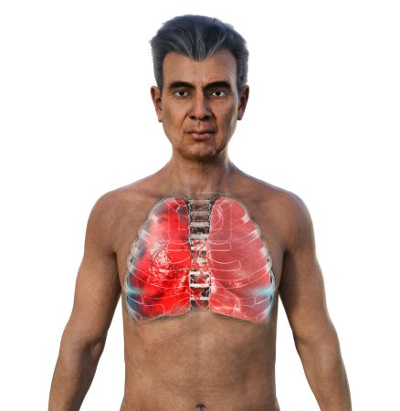 Foto de Una ilustración fotorrealista en 3D que muestra a un hombre con la piel transparente, revelando los pulmones afectados por la neumonía. - Imagen libre de derechos