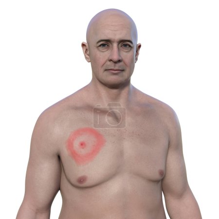 A man with erythema migrans, a characteristic rash of Lyme disease caused by Borrelia burgdorferi. 3D illustration depicts skin lesion progression.