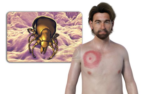 Un homme avec érythème migrant, l'éruption cutanée caractéristique de la maladie de Lyme causée par Borrelia burgdorferi. L'illustration 3D représente la lésion cutanée, une vue rapprochée d'un vecteur de tiques et la bactérie Borrelia.